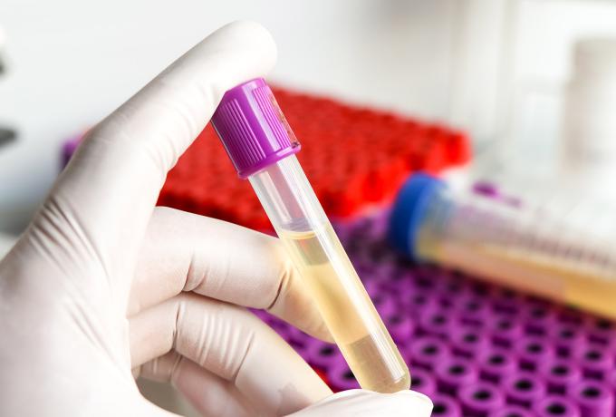 5 Signs of Bladder Cancer that Women Should Know 